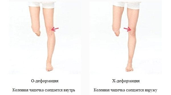 Типы кривизны ног
